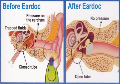 EARDOC v2 GIVES RELIEF FROM EARACHE, EAR PAIN, INFECTION AND OTITIS ...